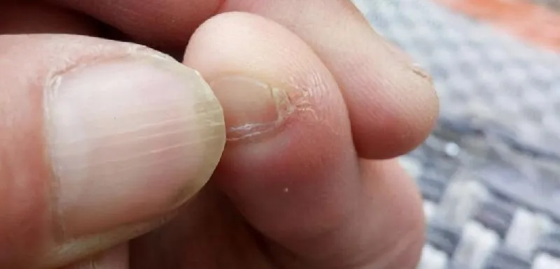 小拇指甲两瓣科学解释 | 脚小拇指甲分两半有什么说法