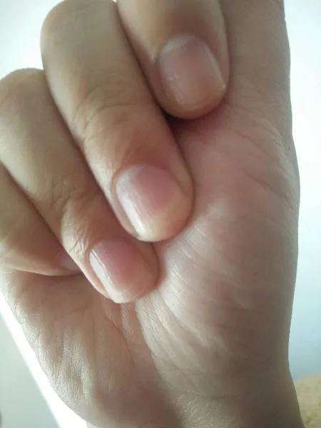 指甲上有竖纹是怎么回事 指甲有竖纹说明哪不好 十个手指甲上都有竖纹